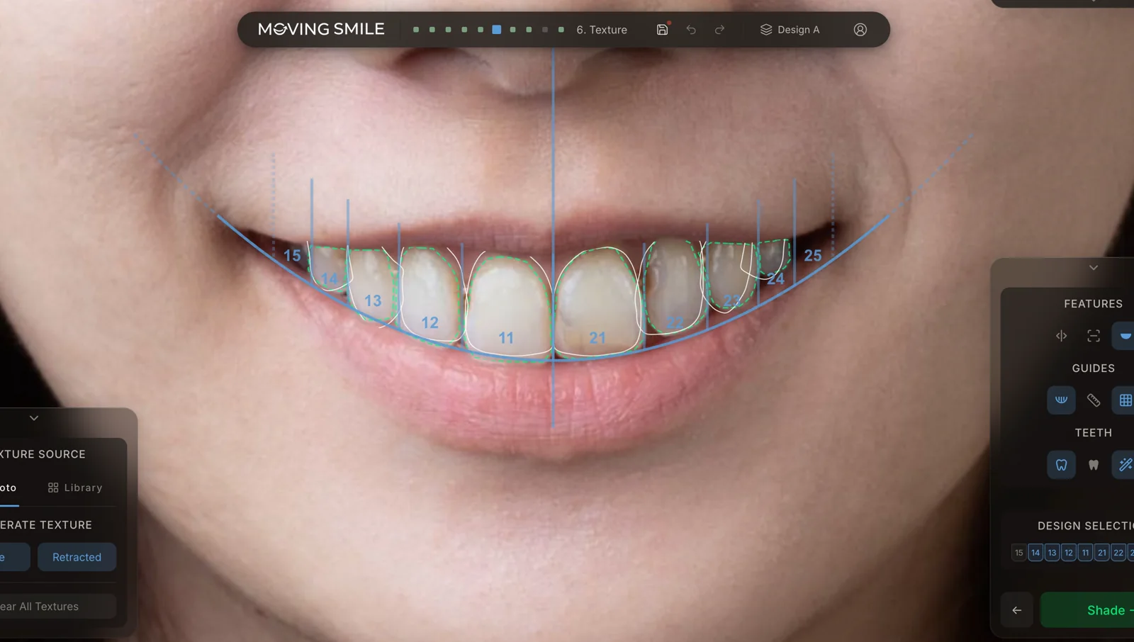 Moving Smile web app showing AI teeth segmentation and smile-design guides over a patient photo